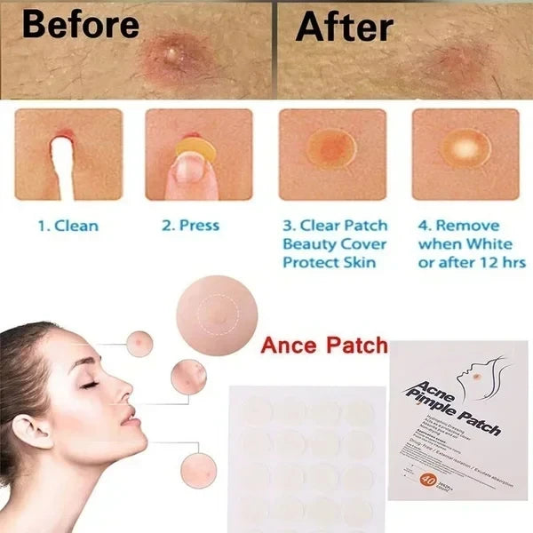 Overnight Acne Healing Patches