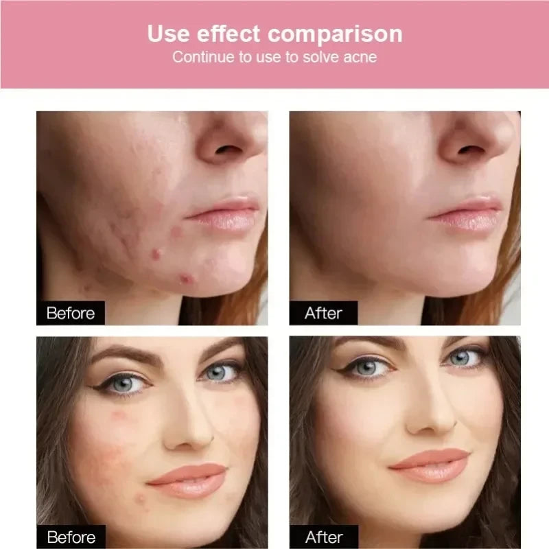 Invisible Hydrocolloid Acne Patches