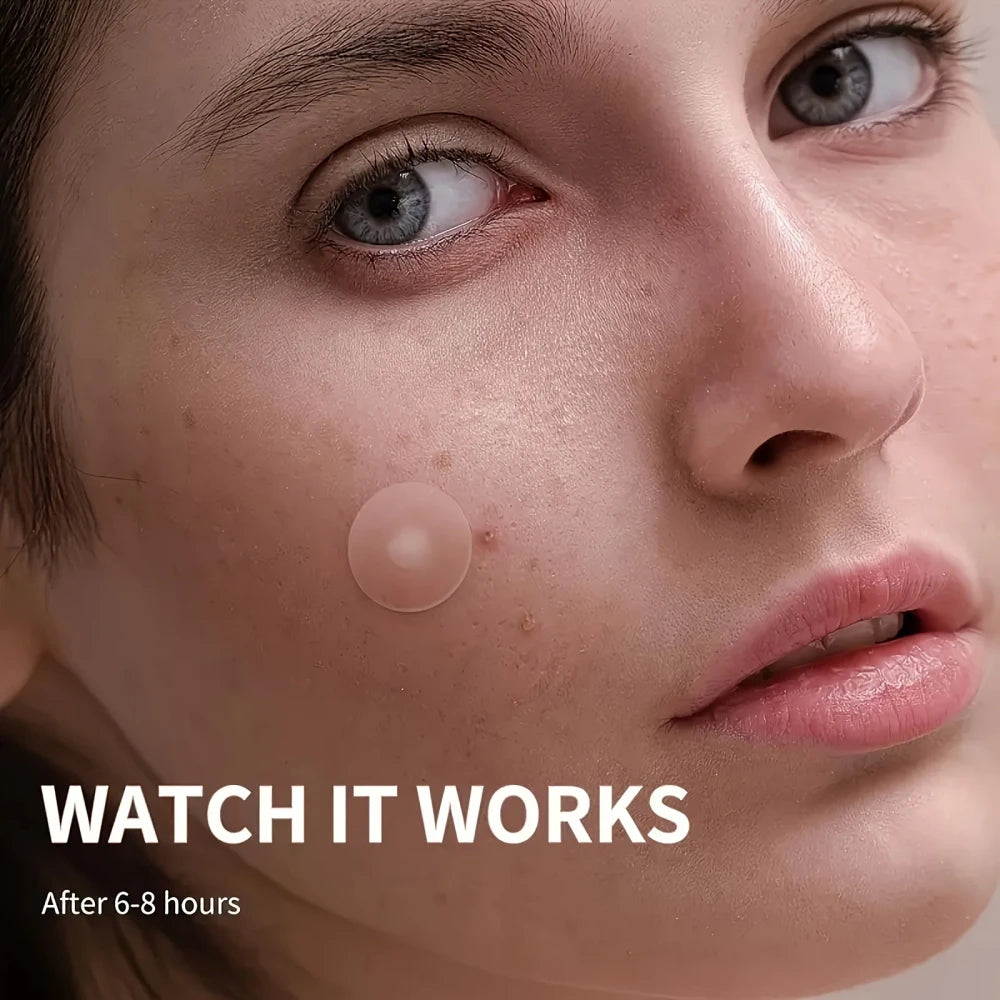 Hydrocolloid Acne Patches