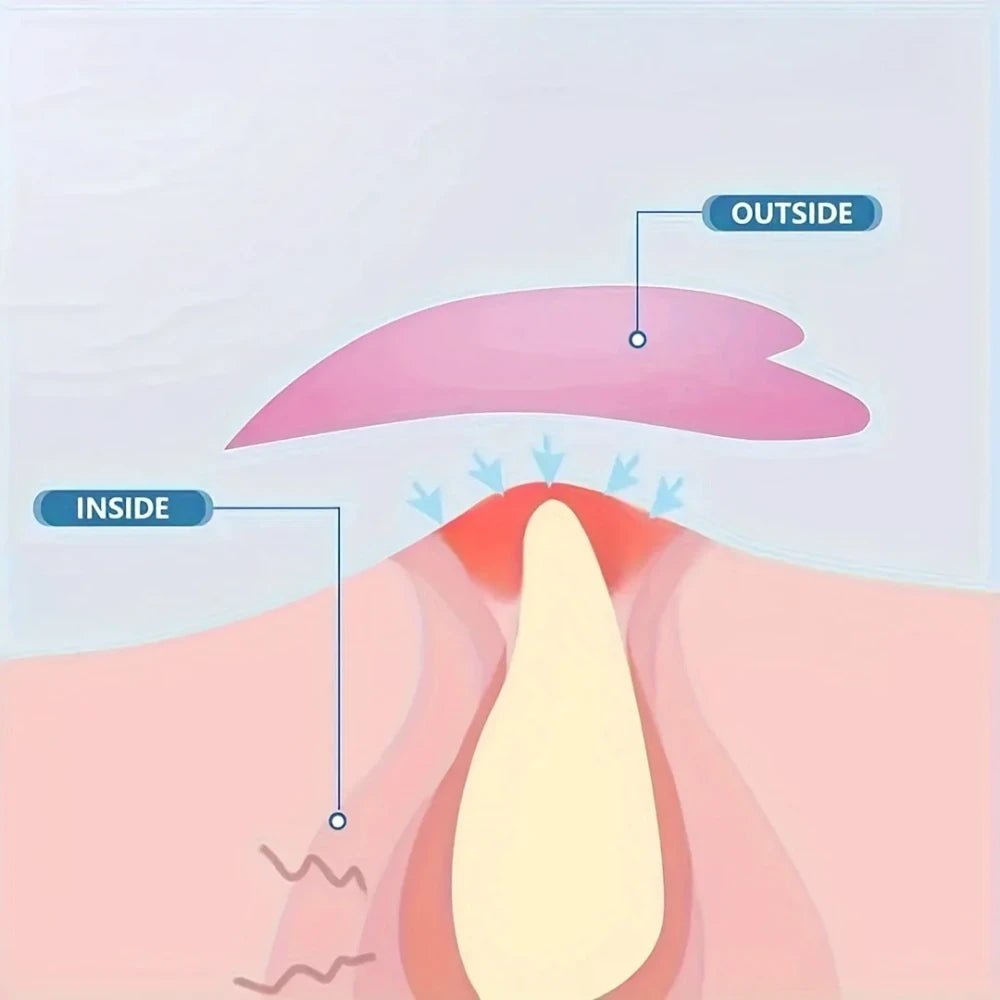 Hydrocolloid Acne Patches
